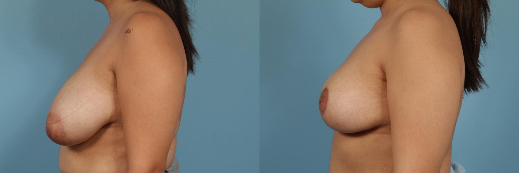 Before & After Breast Reduction Case 233 View #2 View in Chicago, IL