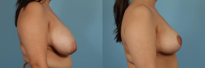 Before & After Breast Reduction Case 233 View #3 View in Chicago, IL