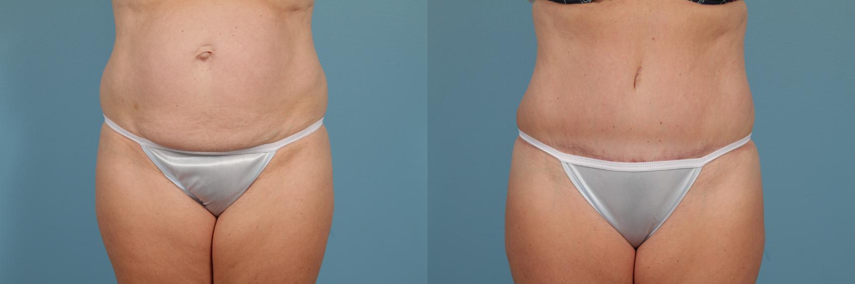 Before & After Breast Reduction Case 237 View #1 View in Chicago, IL