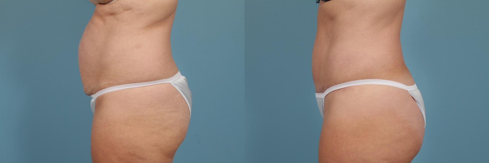 Before & After Breast Reduction Case 237 View #2 View in Chicago, IL