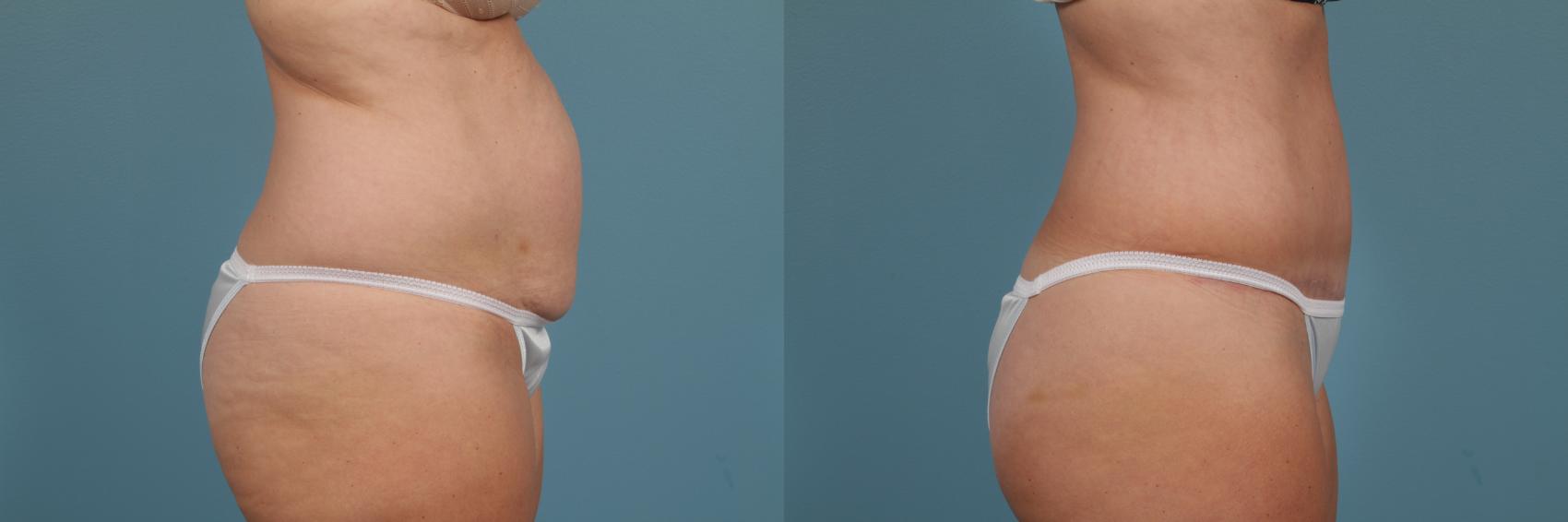 Before & After Breast Reduction Case 237 View #3 View in Chicago, IL