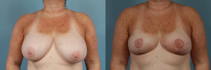 Before & After Breast Reduction Case 254 View #2 View in Chicago, IL