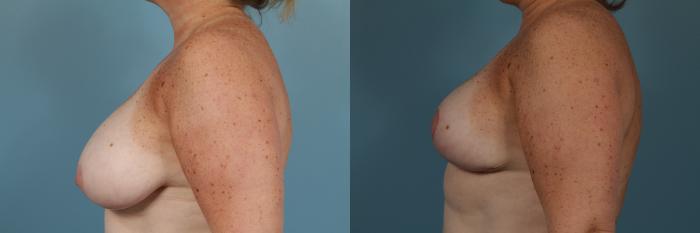 Before & After Breast Reduction Case 254 View #3 View in Chicago, IL