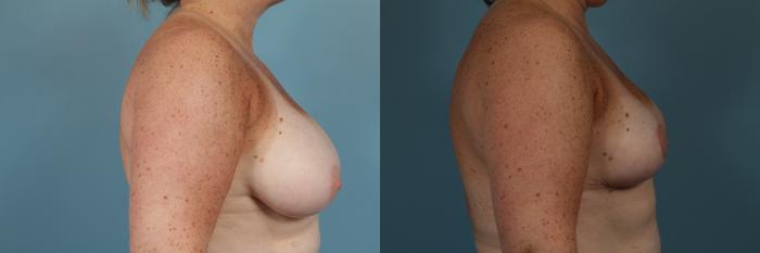 Before & After Breast Reduction Case 254 View #4 View in Chicago, IL