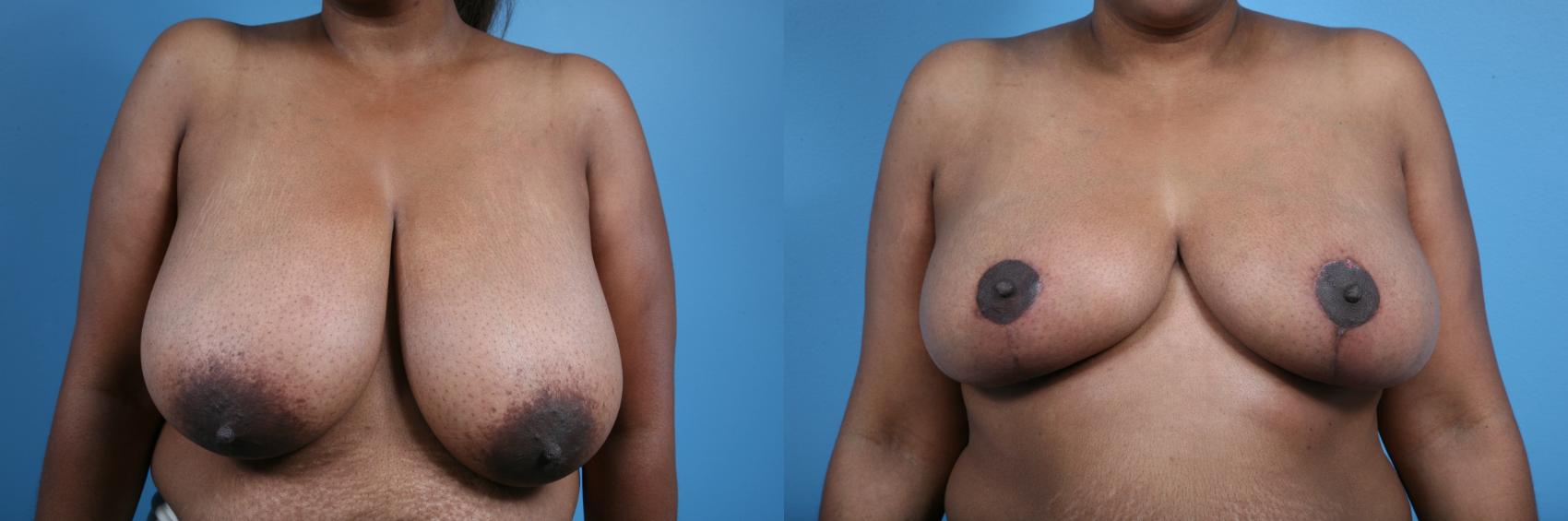 Before & After Breast Reduction Case 26 Front View in Chicago, IL