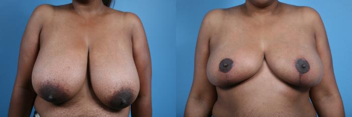 Before & After Breast Reduction Case 26 Front View in Chicago, IL
