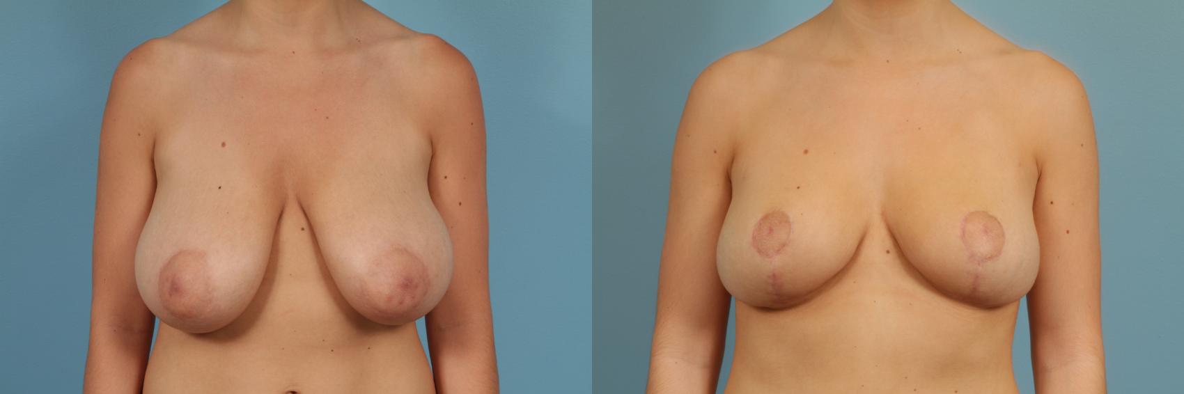 Before & After Breast Reduction Case 264 View #1 View in Chicago, IL