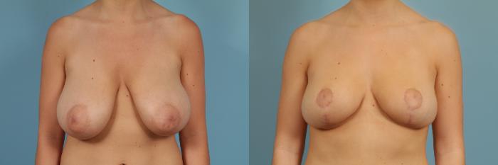 Before & After Breast Reduction Case 264 View #1 View in Chicago, IL