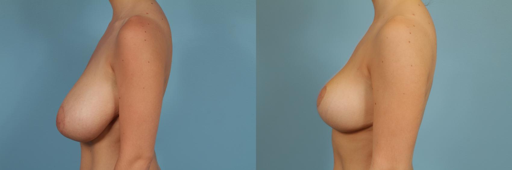 Before & After Breast Reduction Case 264 View #2 View in Chicago, IL