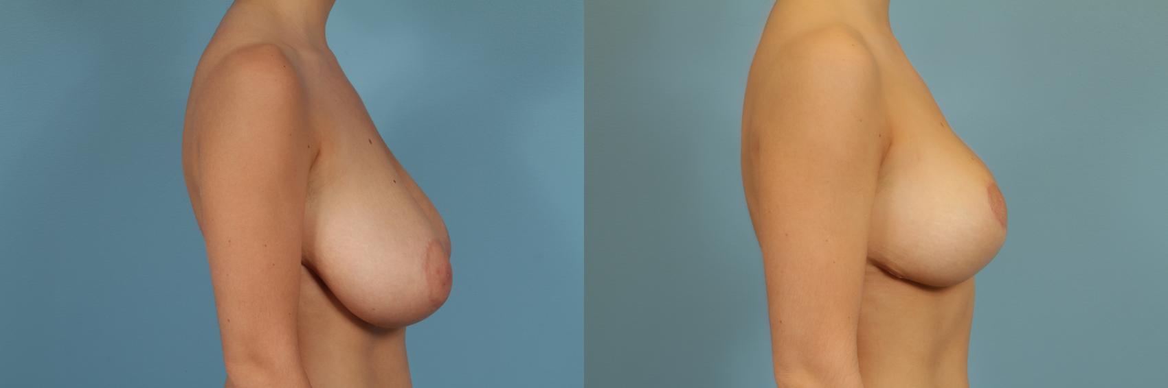 Before & After Breast Reduction Case 264 View #3 View in Chicago, IL