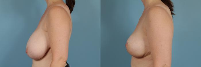 Before & After Breast Reduction Case 265 View #2 View in Chicago, IL
