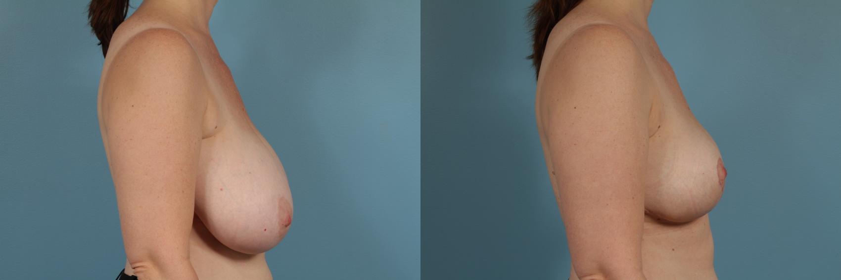 Before & After Breast Reduction Case 265 View #3 View in Chicago, IL
