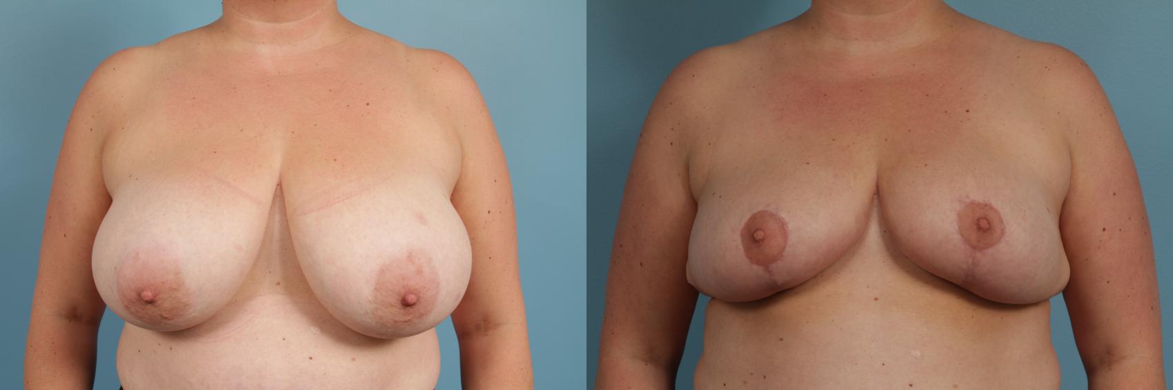 Before & After Breast Reduction Case 287 View #1 View in Chicago, IL