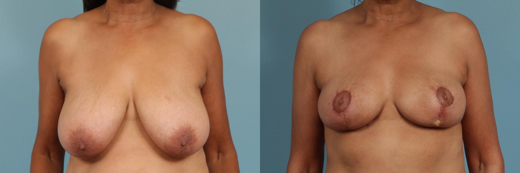 Before & After Breast Reduction Case 292 View #1 View in Chicago, IL