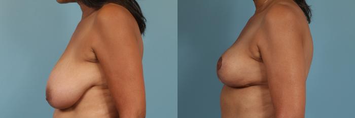 Before & After Breast Reduction Case 292 View #2 View in Chicago, IL