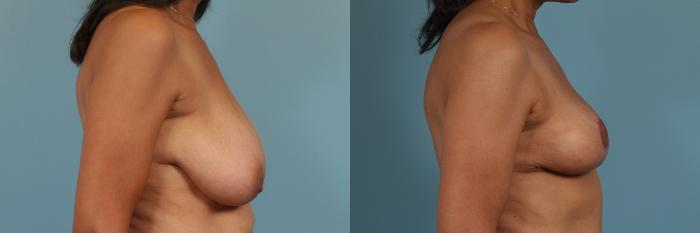 Before & After Breast Reduction Case 292 View #3 View in Chicago, IL