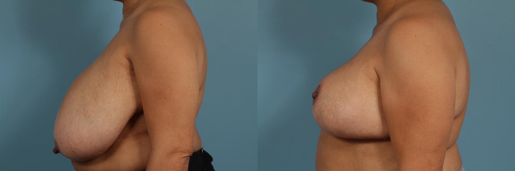 Before & After Breast Reduction Case 302 View #2 View in Chicago, IL