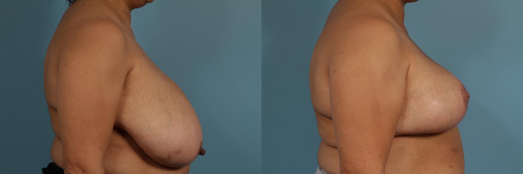 Before & After Breast Reduction Case 302 View #3 View in Chicago, IL