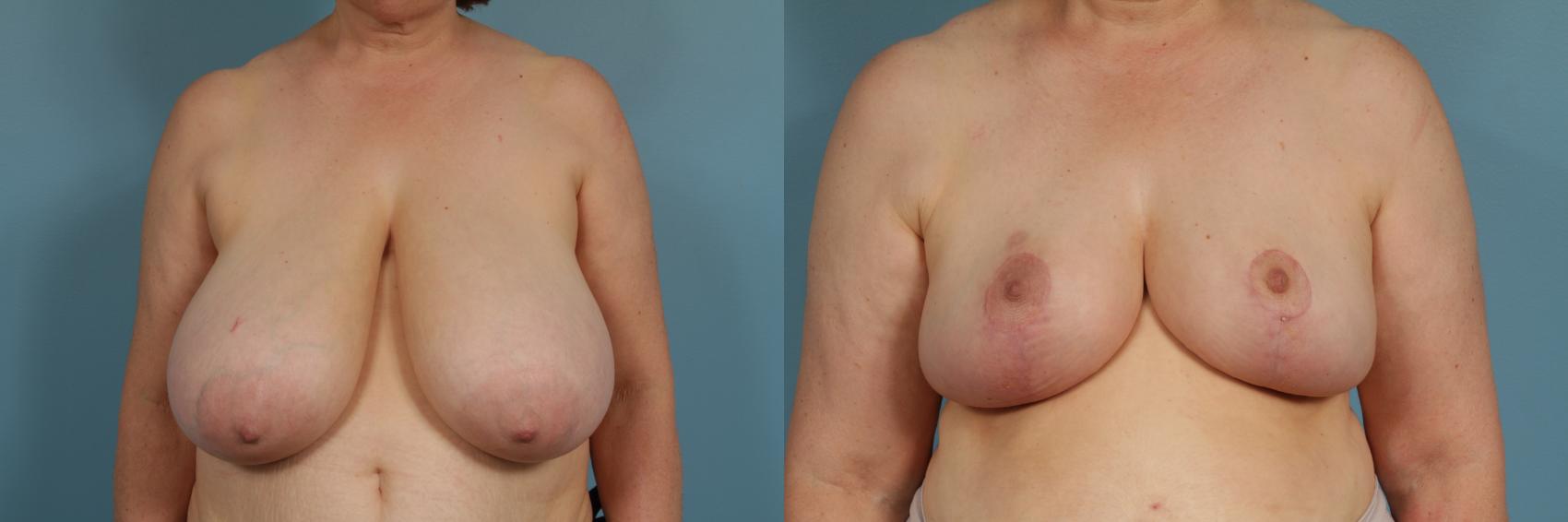 Before & After Breast Reduction Case 311 View #1 View in Chicago, IL