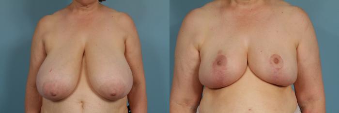Before & After Breast Reduction Case 311 View #1 View in Chicago, IL