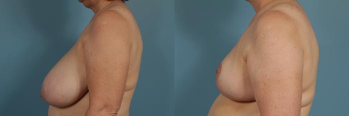Before & After Breast Reduction Case 311 View #2 View in Chicago, IL