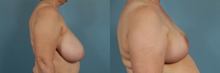 Before & After Breast Reduction Case 311 View #3 View in Chicago, IL