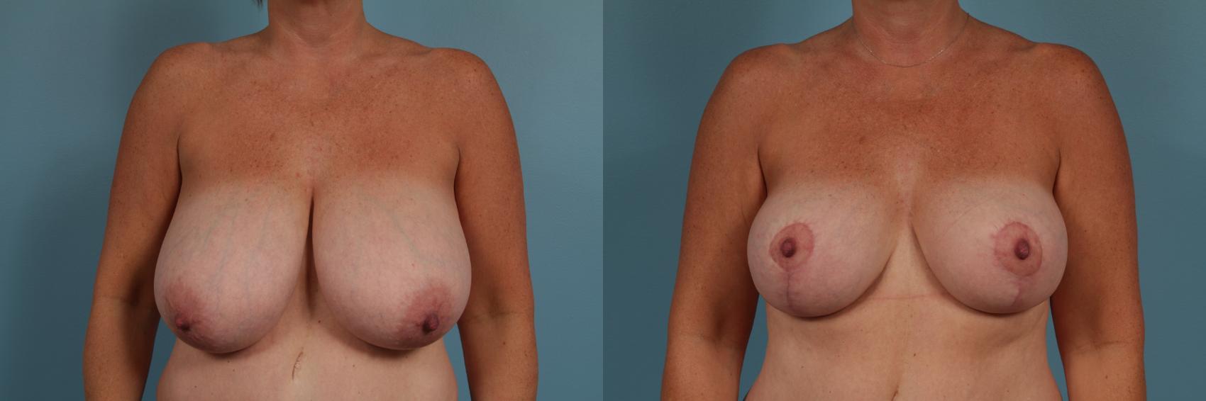 Before & After Breast Reduction Case 317 View #1 View in Chicago, IL