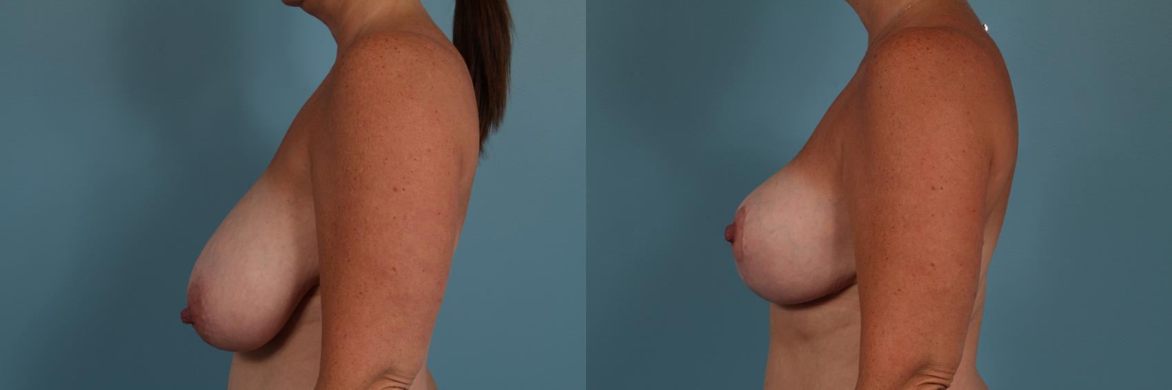Before & After Breast Reduction Case 317 View #2 View in Chicago, IL