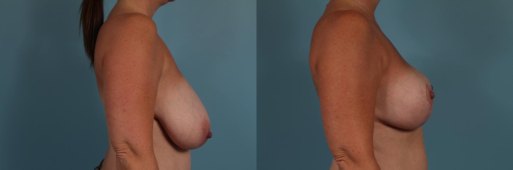Before & After Breast Reduction Case 317 View #3 View in Chicago, IL