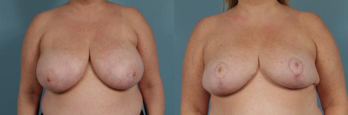 Before & After Breast Reduction Case 328 View #1 View in Chicago, IL