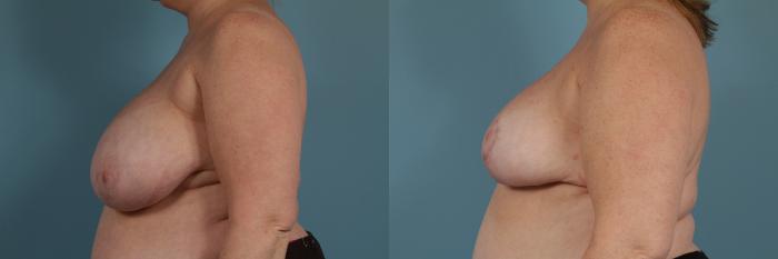 Before & After Breast Reduction Case 328 View #2 View in Chicago, IL