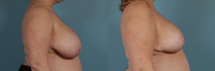 Before & After Breast Reduction Case 328 View #3 View in Chicago, IL