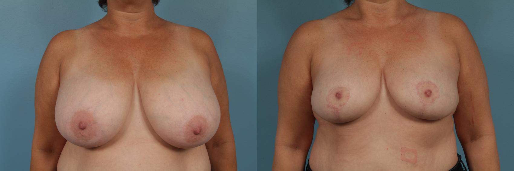 Before & After Breast Reduction Case 345 View #1 View in Chicago, IL