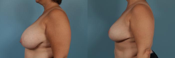 Before & After Breast Reduction Case 345 View #2 View in Chicago, IL