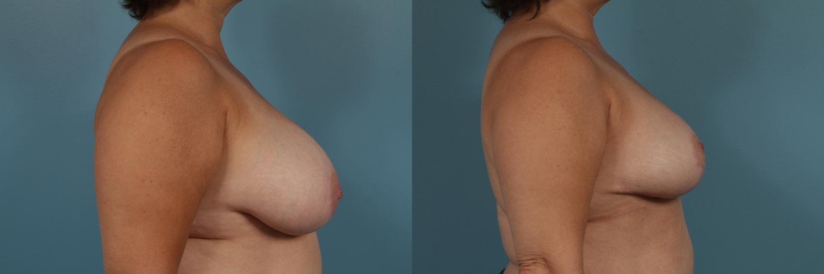 Before & After Breast Reduction Case 345 View #4 View in Chicago, IL