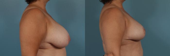 Before & After Breast Reduction Case 345 View #4 View in Chicago, IL