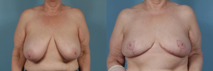 Before & After Breast Reduction Case 365 View #1 View in Chicago, IL