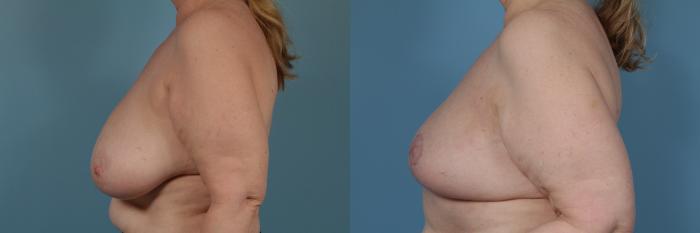 Before & After Breast Reduction Case 365 View #2 View in Chicago, IL