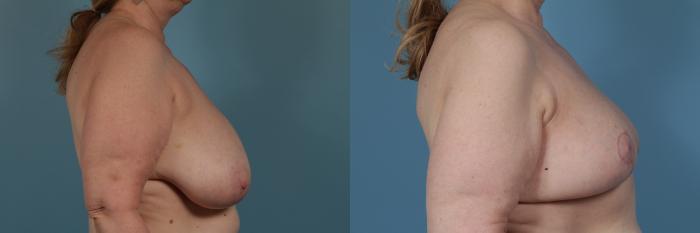 Before & After Breast Reduction Case 365 View #3 View in Chicago, IL