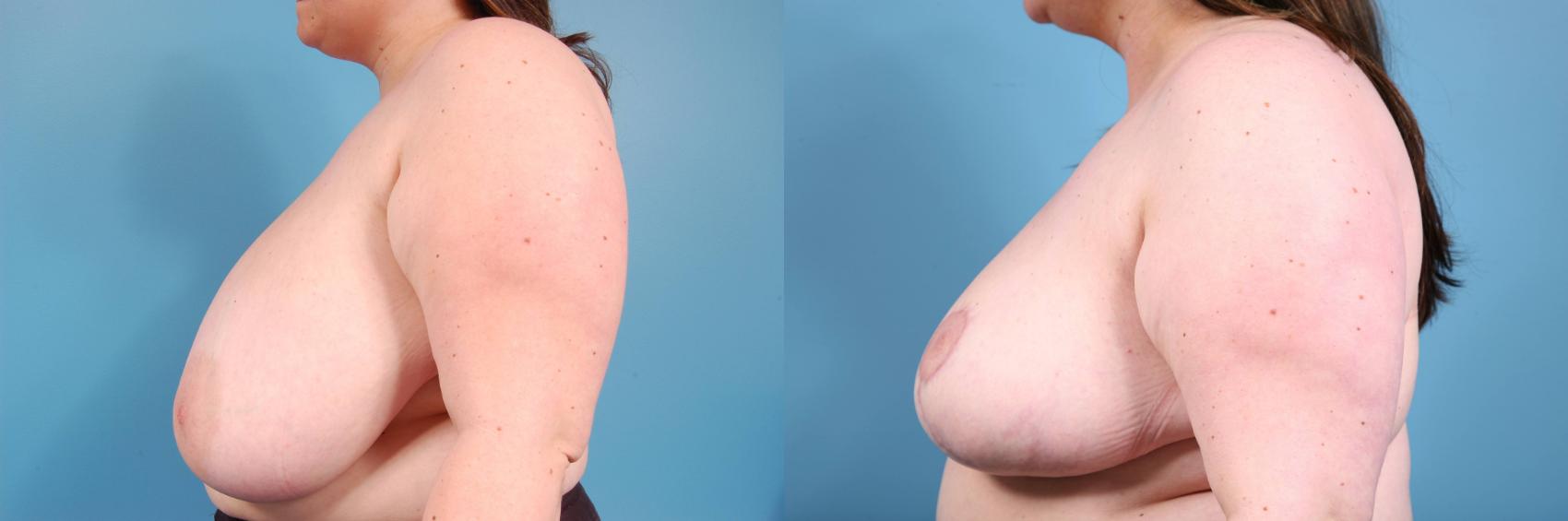 Before & After Breast Reduction Case 37 View #2 View in Chicago, IL