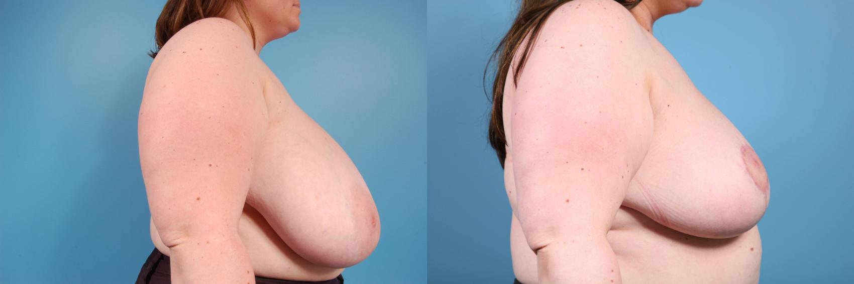Before & After Breast Reduction Case 37 View #3 View in Chicago, IL