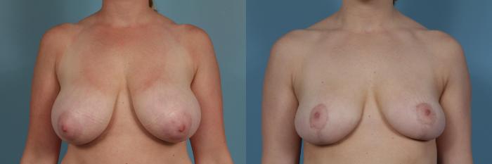 Before & After Breast Reduction Case 382 View #1 View in Chicago, IL
