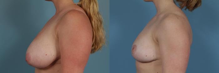 Before & After Breast Reduction Case 382 View #3 View in Chicago, IL