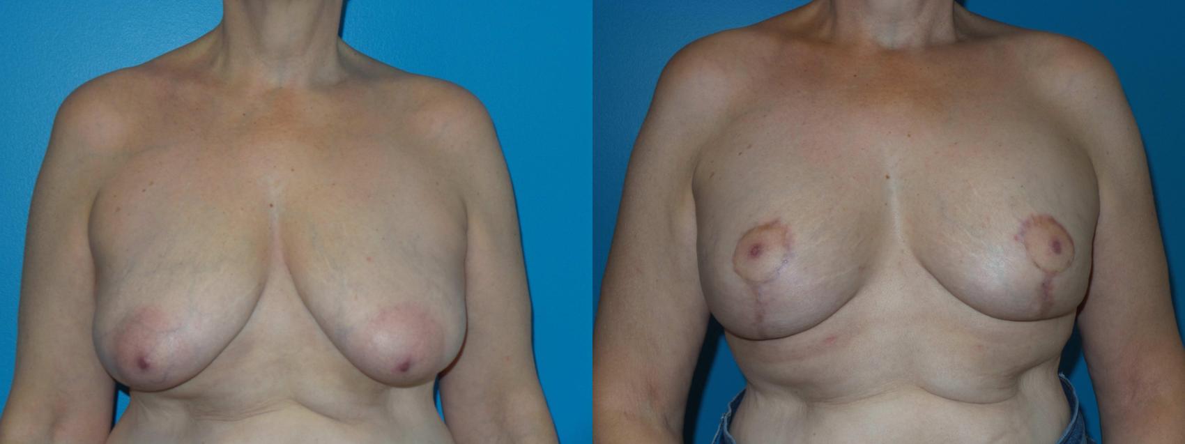 Before & After Breast Reduction Case 419 View #1 View in Chicago, IL