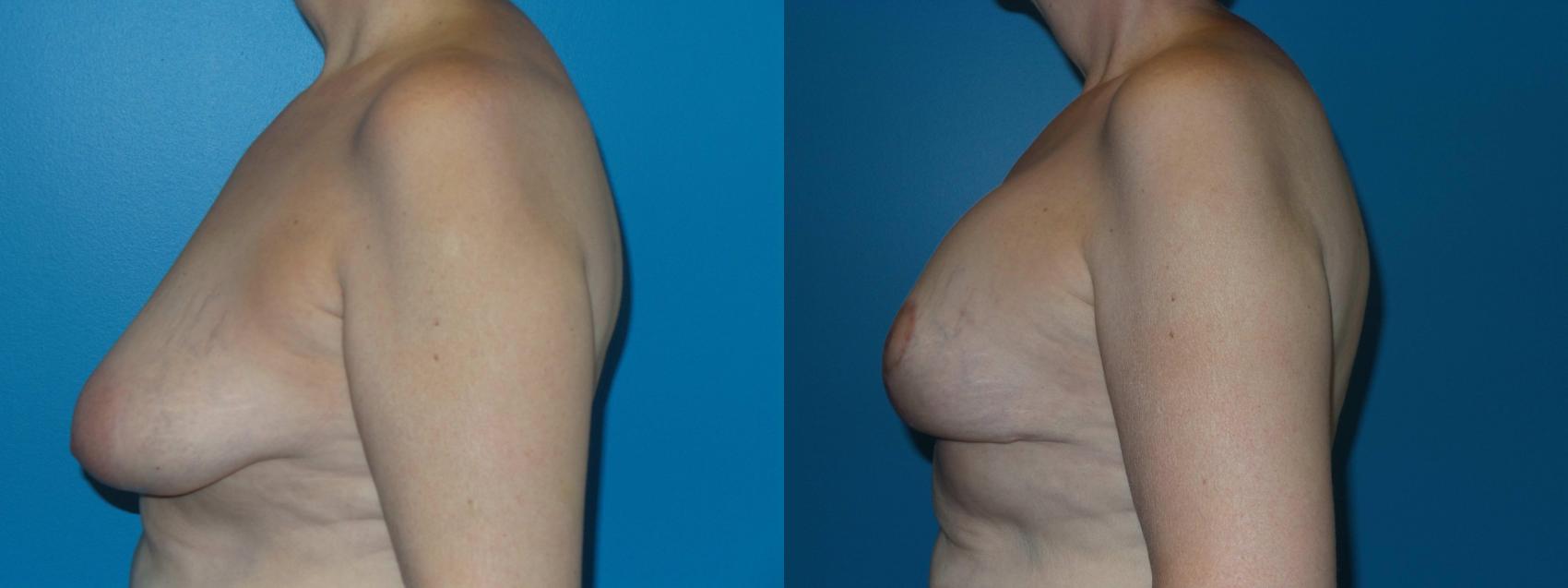 Before & After Breast Reduction Case 419 View #2 View in Chicago, IL