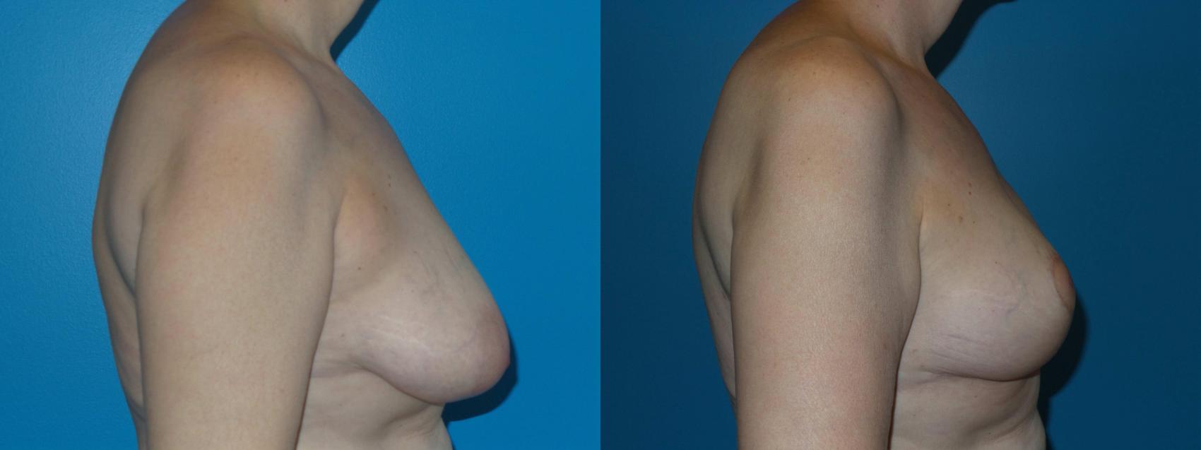 Before & After Breast Reduction Case 419 View #3 View in Chicago, IL