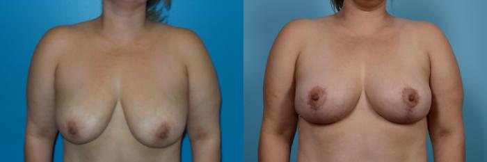Before & After Breast Reduction Case 450 View #1 View in Chicago, IL