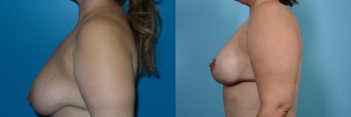 Before & After Breast Reduction Case 450 View #2 View in Chicago, IL