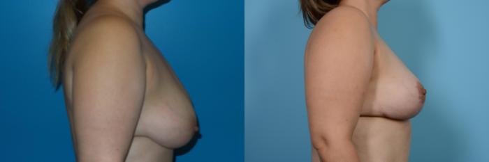 Before & After Breast Reduction Case 450 View #3 View in Chicago, IL