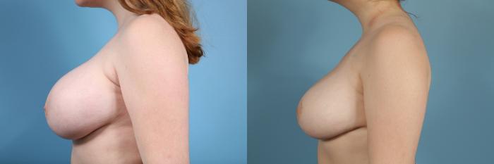 Before & After Breast Reduction Case 46 View #2 View in Chicago, IL